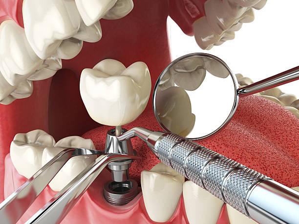 Best Emergency Wisdom Teeth Removal in Garnet, CA